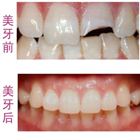 烤瓷牙多少钱一颗，全瓷牙在3000元到6000元