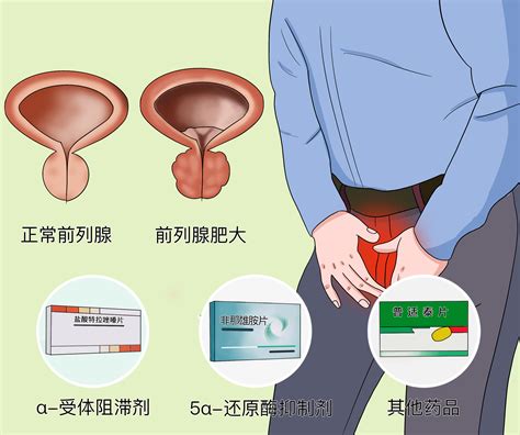 前列腺炎如何治疗？ 药物