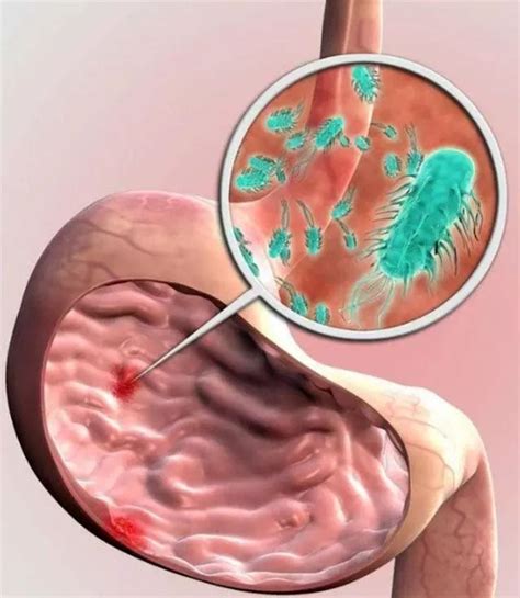 胃黏膜糜烂，幽门螺杆菌是元凶!
